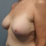 Breast Augmentation Revision (Breast Enlargement Repair) Before & After Patient #7185
