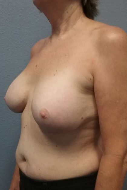 Breast Augmentation Revision (Breast Enlargement Repair) Before & After Patient #7185