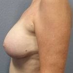 Breast Augmentation Revision (Breast Enlargement Repair) Before & After Patient #7185