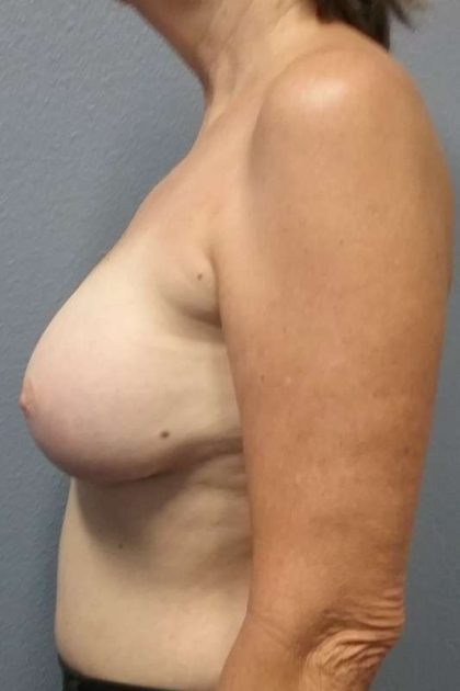 Breast Augmentation Revision (Breast Enlargement Repair) Before & After Patient #7185