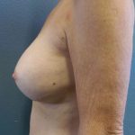 Breast Augmentation Revision (Breast Enlargement Repair) Before & After Patient #7185