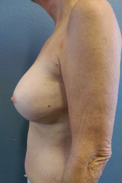 Breast Augmentation Revision (Breast Enlargement Repair) Before & After Patient #7185
