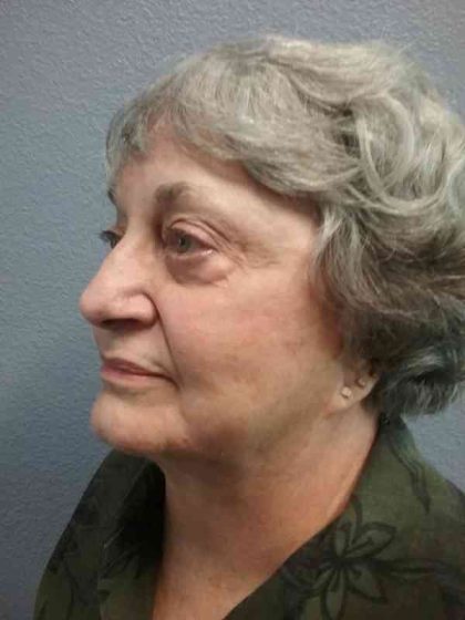 Periorbital Before & After Patient #8616