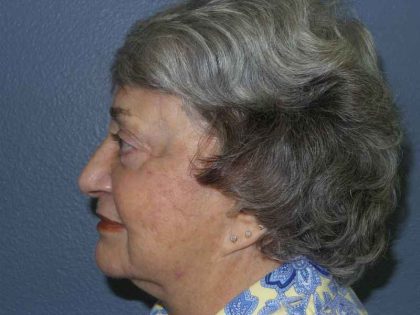 Periorbital Before & After Patient #8616