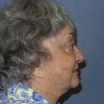 Periorbital Before & After Patient #8616
