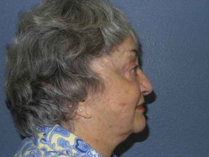 Periorbital Before & After Patient #8616