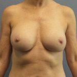 Breast Augmentation Revision (Breast Enlargement Repair) Before & After Patient #7174