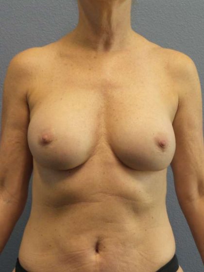 Breast Augmentation Revision (Breast Enlargement Repair) Before & After Patient #7174