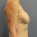 Breast Augmentation Revision (Breast Enlargement Repair) Before & After Patient #7174