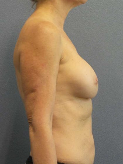 Breast Augmentation Revision (Breast Enlargement Repair) Before & After Patient #7174