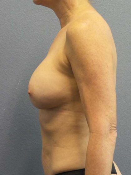 Breast Augmentation Revision (Breast Enlargement Repair) Before & After Patient #7174