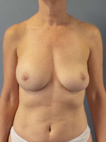 Breast Augmentation Revision (Breast Enlargement Repair) Before & After Patient #7174
