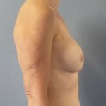 Breast Augmentation Revision (Breast Enlargement Repair) Before & After Patient #7174