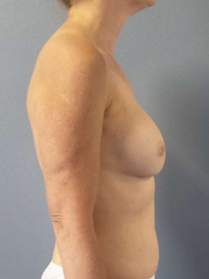 Breast Augmentation Revision (Breast Enlargement Repair) Before & After Patient #7174