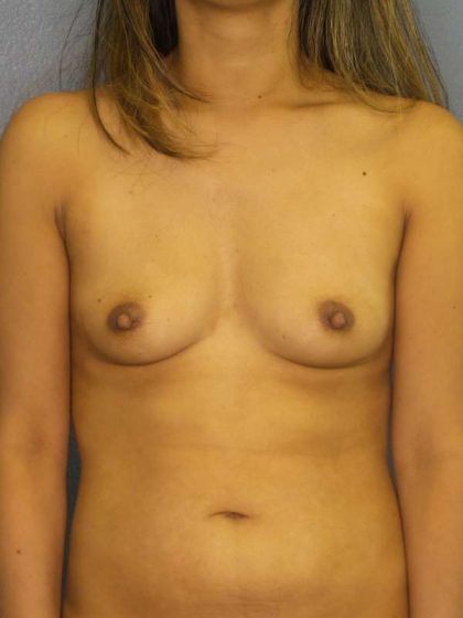 Breast Augmentation Before & After Patient #6546