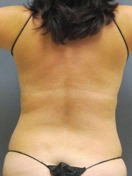 Liposuction Female Before & After Patient #7913