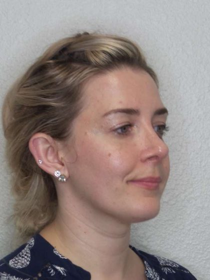 Rhinoplasty Before & After Patient #10018