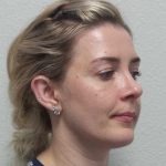 Rhinoplasty Before & After Patient #10018