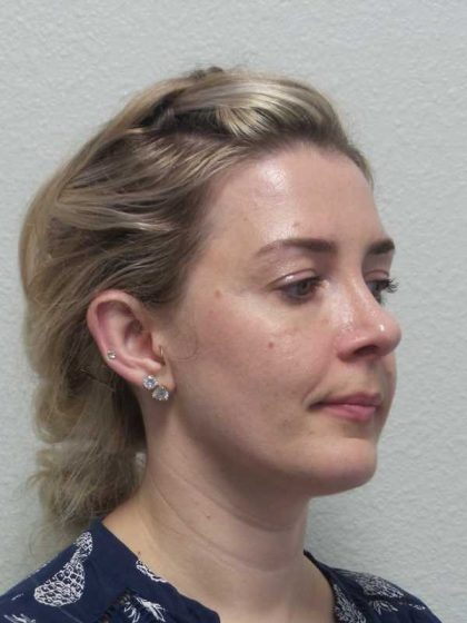 Rhinoplasty Before & After Patient #10018