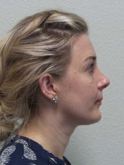 Rhinoplasty Before & After Patient #10018