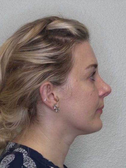 Rhinoplasty Before & After Patient #10018