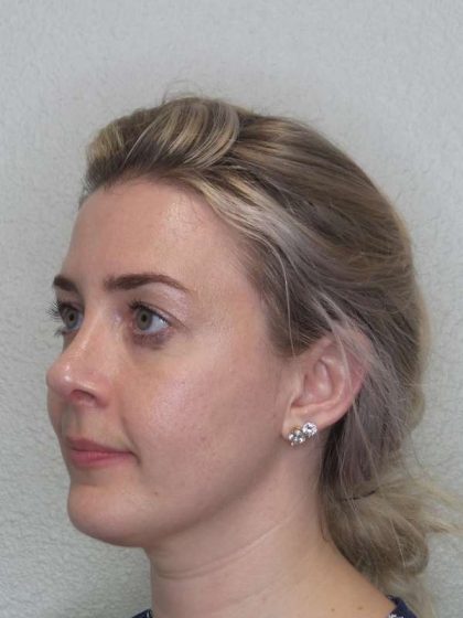 Rhinoplasty Before & After Patient #10018