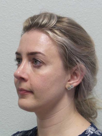 Rhinoplasty Before & After Patient #10018