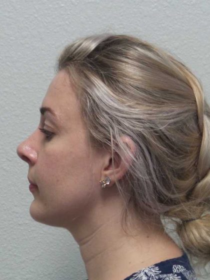 Rhinoplasty Before & After Patient #10018