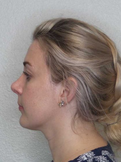Rhinoplasty Before & After Patient #10018