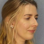 Rhinoplasty Before & After Patient #10018