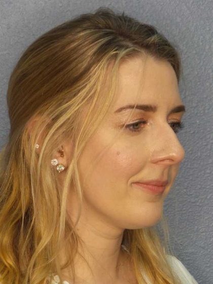 Rhinoplasty Before & After Patient #10018