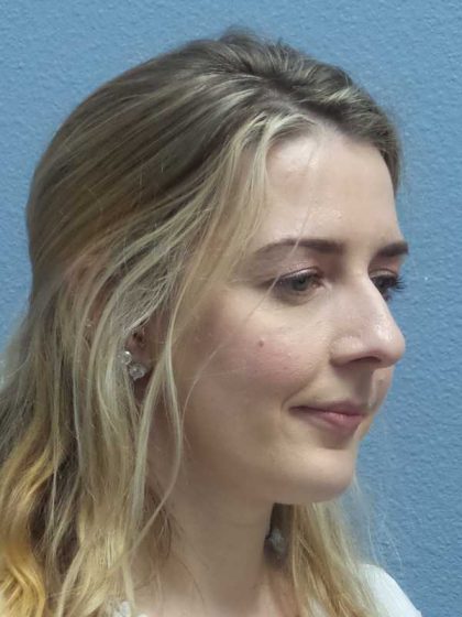 Rhinoplasty Before & After Patient #10018