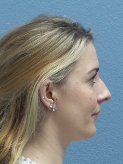 Rhinoplasty Before & After Patient #10018