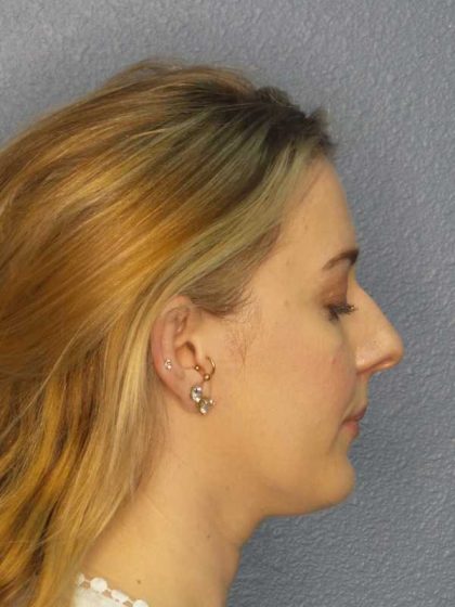 Rhinoplasty Before & After Patient #10018