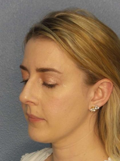 Rhinoplasty Before & After Patient #10018