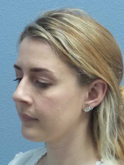 Rhinoplasty Before & After Patient #10018
