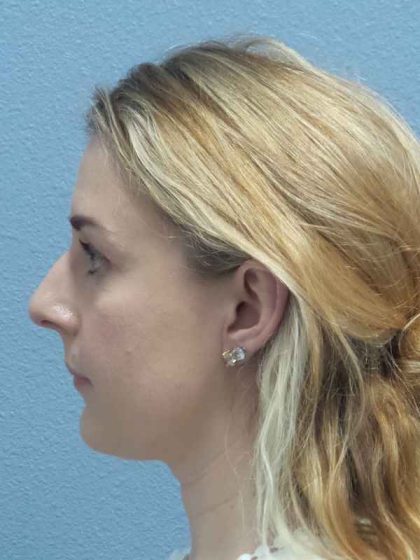 Rhinoplasty Before & After Patient #10018