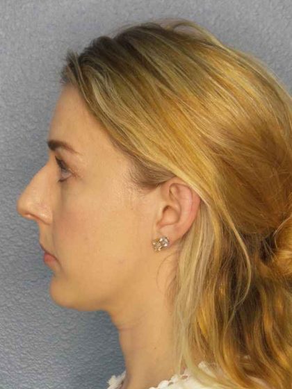 Rhinoplasty Before & After Patient #10018