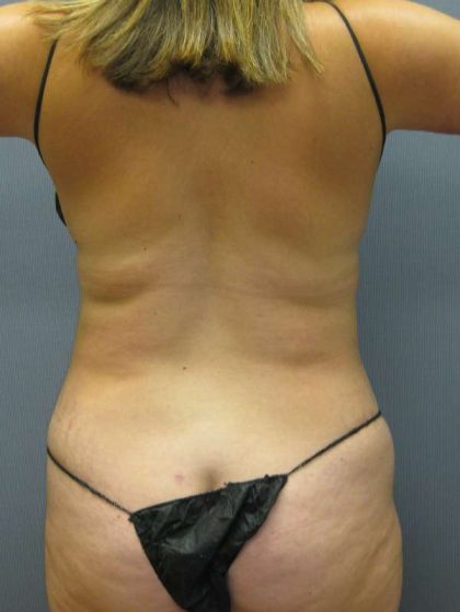 Liposuction Female Before & After Patient #8041