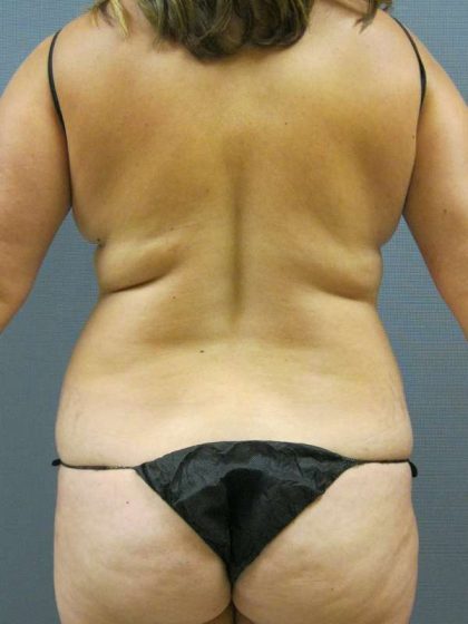 Liposuction Female Before & After Patient #8041