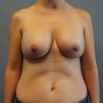 Asymmetric (Uneven) Breasts Before & After Patient #5011