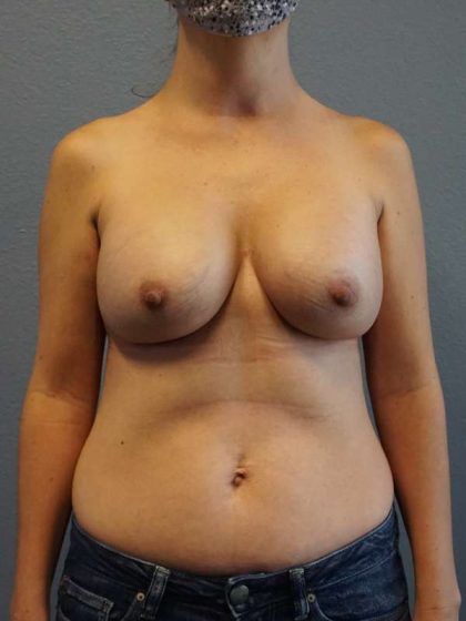 Asymmetric (Uneven) Breasts Before & After Patient #5011