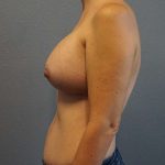 Asymmetric (Uneven) Breasts Before & After Patient #5011