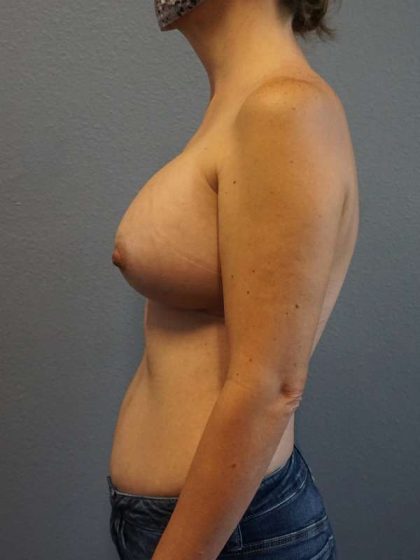 Asymmetric (Uneven) Breasts Before & After Patient #5011
