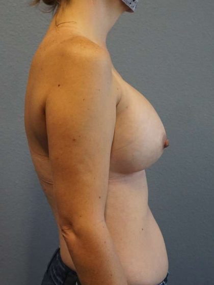 Asymmetric (Uneven) Breasts Before & After Patient #5011