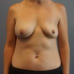 Asymmetric (Uneven) Breasts Before & After Patient #5011
