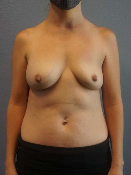 Asymmetric (Uneven) Breasts Before & After Patient #5011