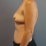 Asymmetric (Uneven) Breasts Before & After Patient #5011