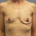 Asymmetric (Uneven) Breasts Before & After Patient #7024