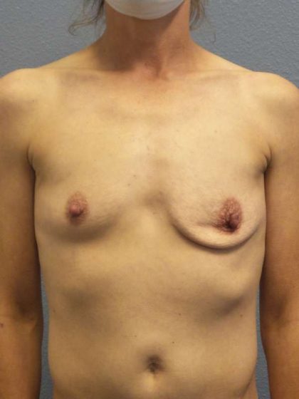 Asymmetric (Uneven) Breasts Before & After Patient #7024